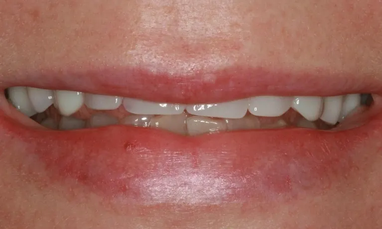 Before: short, worn and uneven upper front teeth.