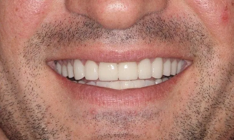 After: crowns restoring the length and shape of the upper teeth.